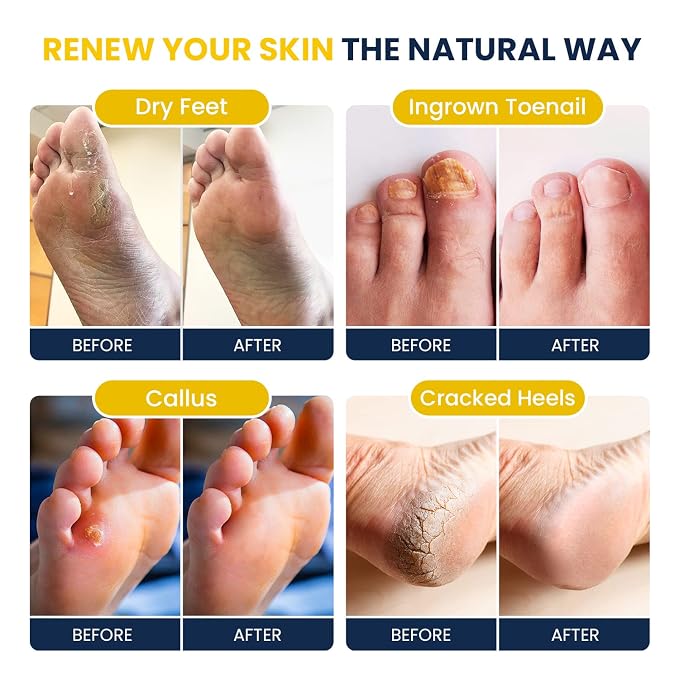 Citrus Detox Foot Soak With Epsom Salts - for Foot Callus, Immune Boost, Damaged Toenail, Athletes Foot, Pedicure For Dry Cracked Feet - Instantly Hydrates & Soothes Irritated Skin